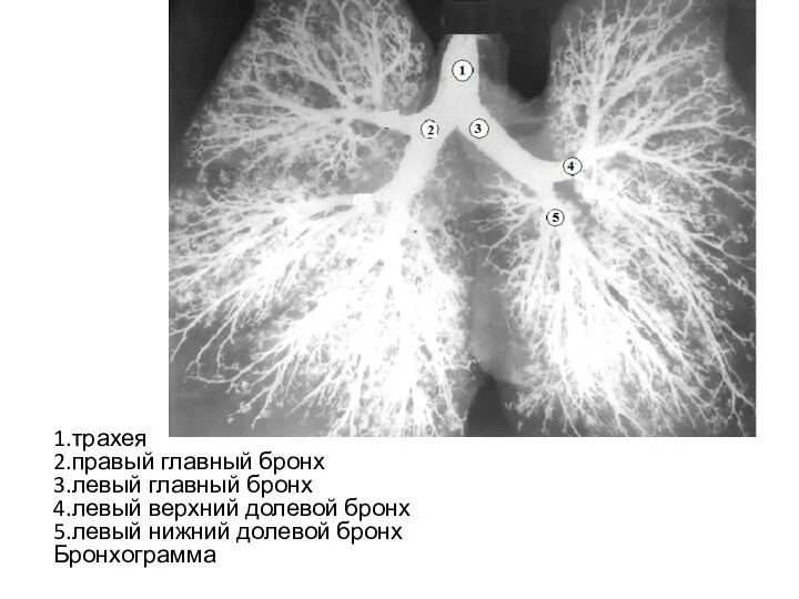 1.трахея 2.правый главный бронх 3.левый главный бронх 4.левый верхний долевой бронх 5.левый нижний долевой бронх Бронхограмма