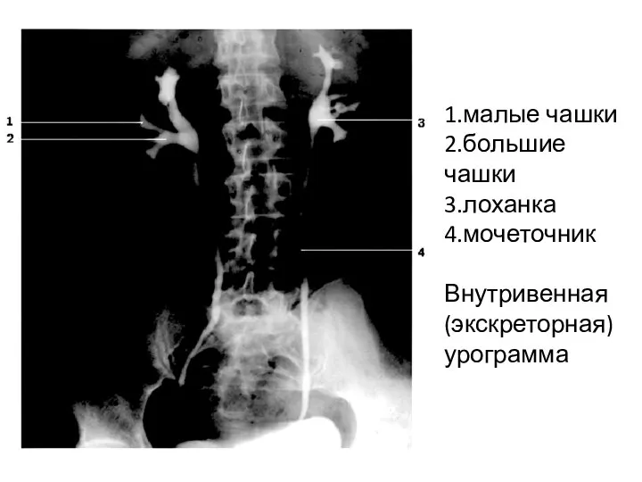 1.малые чашки 2.большие чашки 3.лоханка 4.мочеточник Внутривенная (экскреторная) урограмма