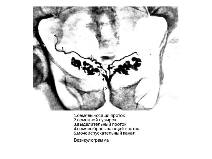 1.семявыносящй проток 2.семенной пузырек 3.выделительный проток 4.семявыбрасывающий проток 5.мочеиспускательный канал Везикулограмма
