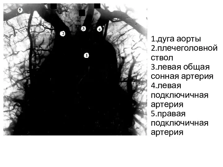 2 3 5 1.дуга аорты 2.плечеголовной ствол 3.левая общая сонная артерия 4.левая