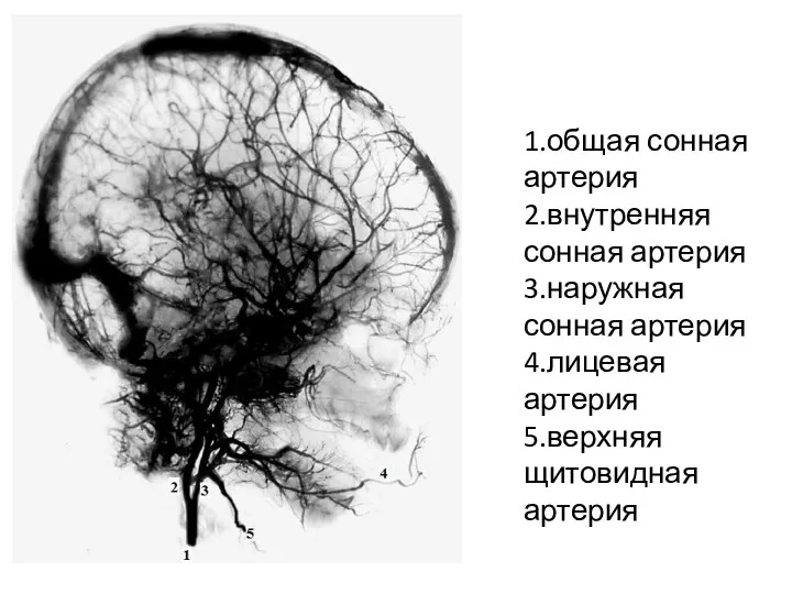 1.общая сонная артерия 2.внутренняя сонная артерия 3.наружная сонная артерия 4.лицевая артерия 5.верхняя щитовидная артерия