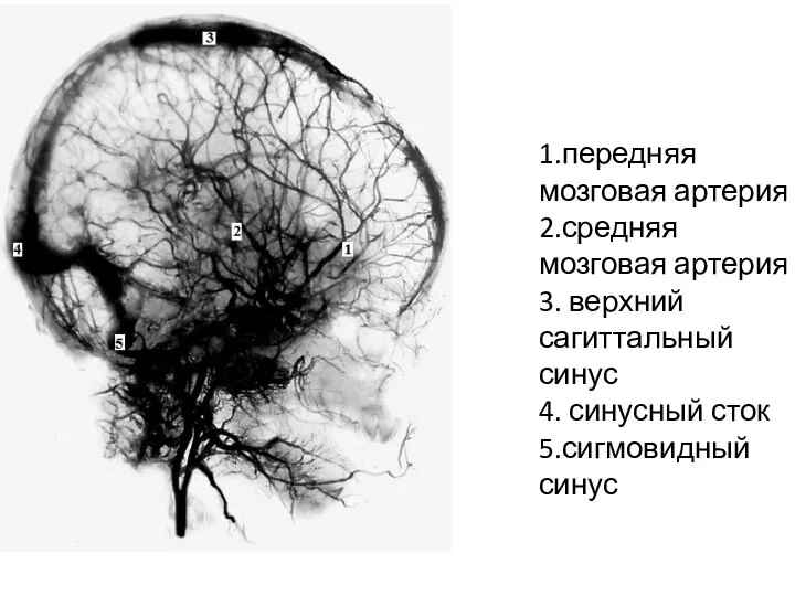 1.передняя мозговая артерия 2.средняя мозговая артерия 3. верхний сагиттальный синус 4. синусный сток 5.сигмовидный синус