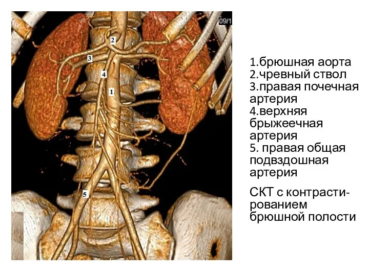 1 5 4 3 1.брюшная аорта 2.чревный ствол 3.правая почечная артерия 4.верхняя