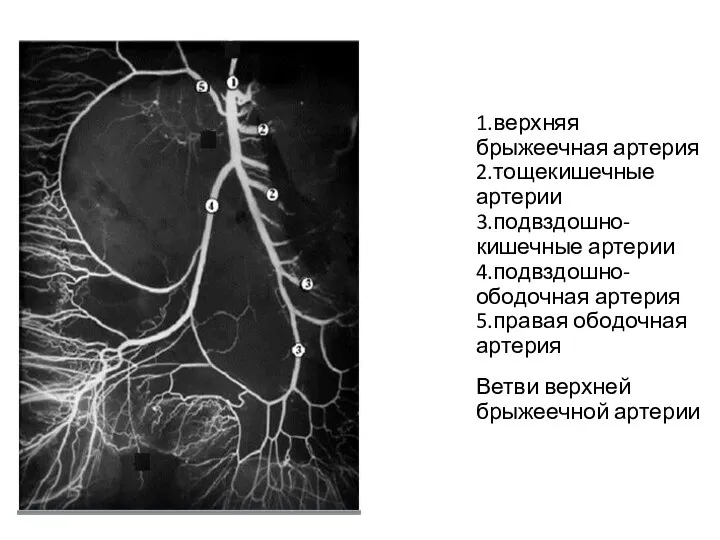 1.верхняя брыжеечная артерия 2.тощекишечные артерии 3.подвздошно-кишечные артерии 4.подвздошно-ободочная артерия 5.правая ободочная артерия Ветви верхней брыжеечной артерии