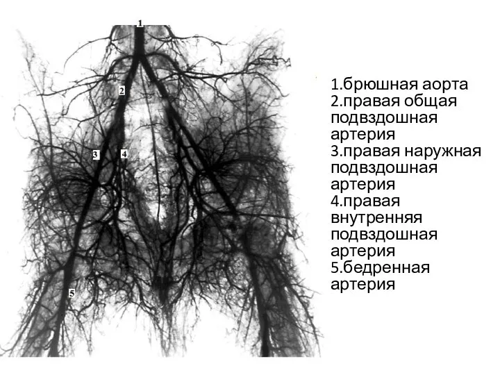 1.брюшная аорта 2.правая общая подвздошная артерия 3.правая наружная подвздошная артерия 4.правая внутренняя подвздошная артерия 5.бедренная артерия