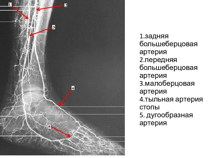 1.задняя большеберцовая артерия 2.передняя большеберцовая артерия 3.малоберцовая артерия 4.тыльная артерия стопы 5. дугообразная артерия
