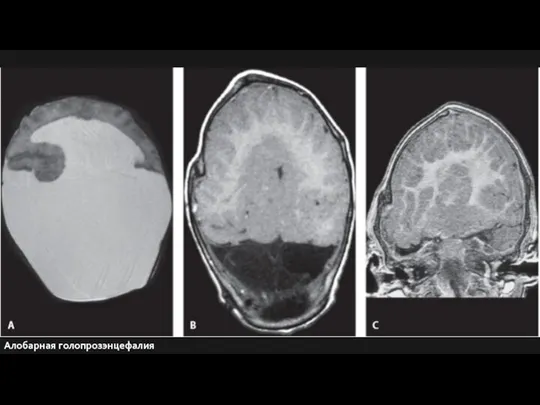 Алобарная голопрозэнцефалия