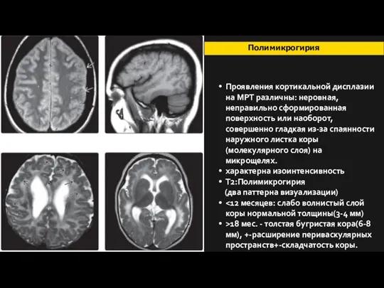 Проявления кортикальной дисплазии на МРТ различны: неровная, неправильно сформированная поверхность или наоборот,