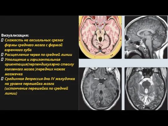 Визуализация: Схожесть на аксиальных срезах формы среднего мозга с формой коренного зуба
