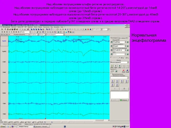 Над обоими полушариями альфа-ритм не pегистpиpуется.. Над обоими полушариями наблюдается низкочастотный бета-ритм