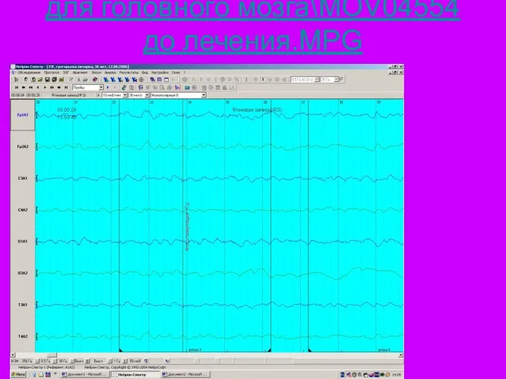 для головного мозга\MOV04554 до лечения.MPG