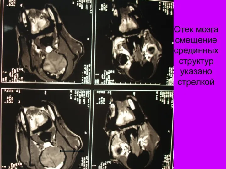 Отек мозга смещение срединных структур указано стрелкой