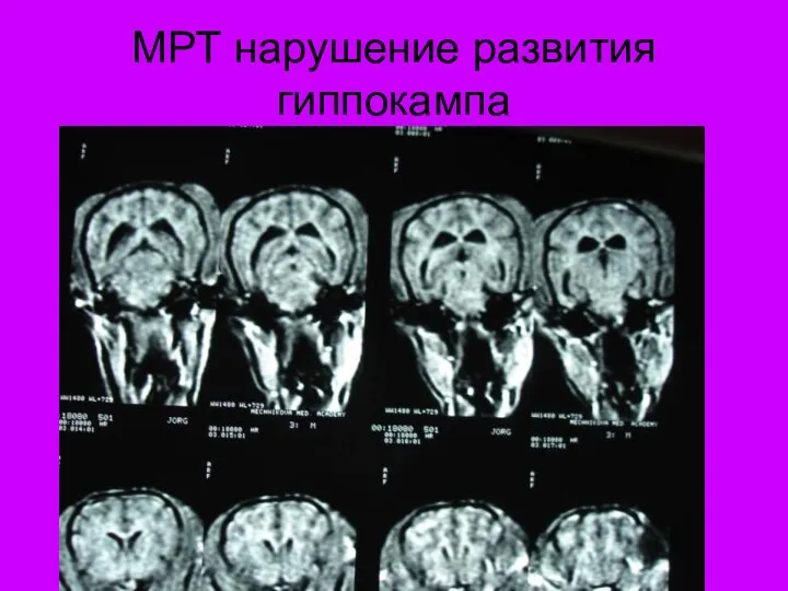 МРТ нарушение развития гиппокампа