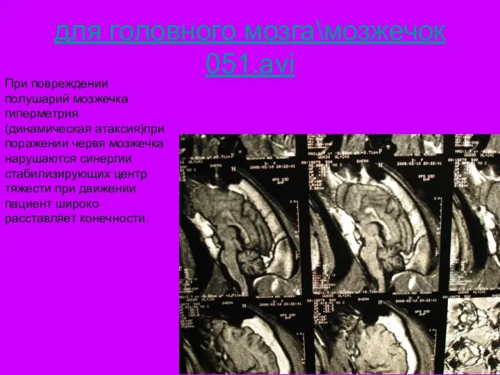для головного мозга\мозжечок 051.avi При повреждении полушарий мозжечка гиперметрия (динамическая атаксия)при поражении