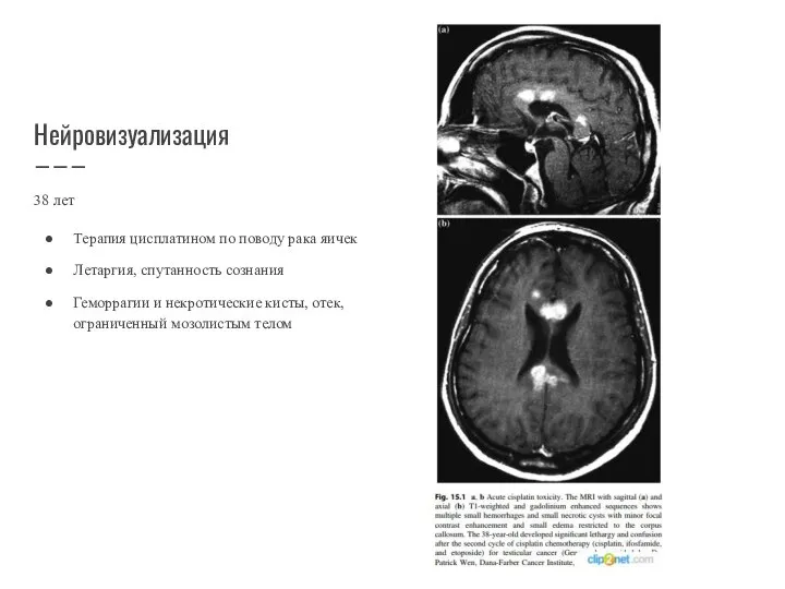 Нейровизуализация 38 лет Терапия цисплатином по поводу рака яичек Летаргия, спутанность сознания