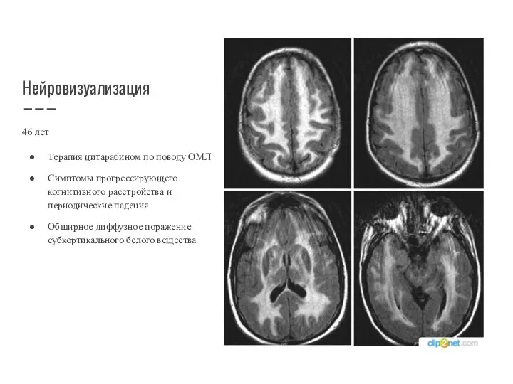 Нейровизуализация 46 лет Терапия цитарабином по поводу ОМЛ Симптомы прогрессирующего когнитивного расстройства