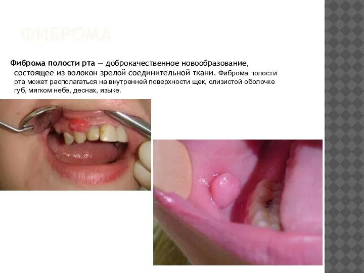 ФИБРОМА Фиброма полости рта — доброкачественное новообразование, состоящее из волокон зрелой соединительной