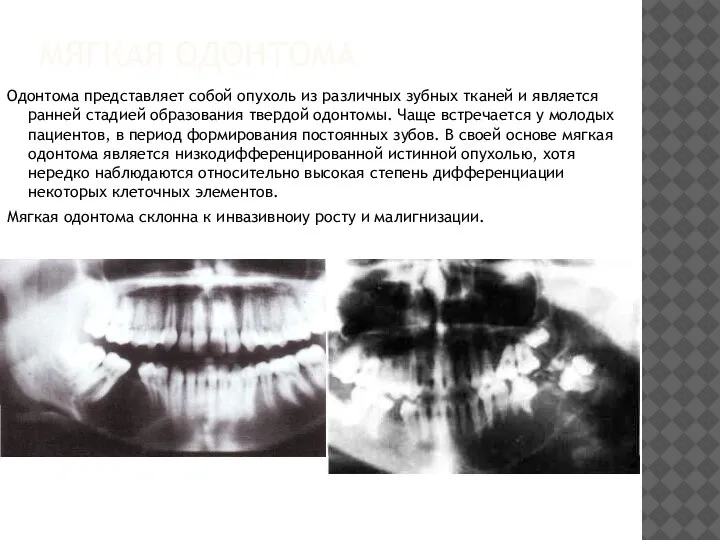 МЯГКАЯ ОДОНТОМА Одонтома представляет собой опухоль из различных зубных тканей и является