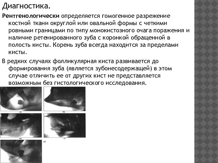 Диагностика. Рентгенологически определяется гомогенное разрежение костной ткани округлой или овальной формы с