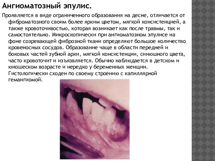 Ангиоматозный эпулис. Проявляется в виде ограниченного образования на десне, отличается от фиброматозного