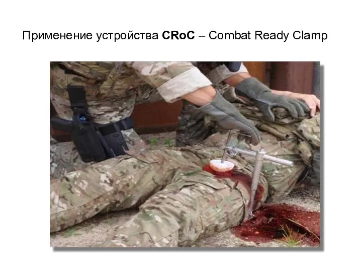 Применение устройства CRoC – Combat Ready Clamp