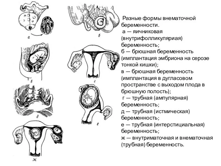 Разные формы внематочной беременности. а — яичниковая (внутрифолликуляриая) беременность; б — брюшная