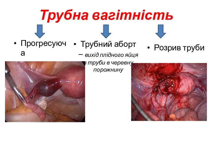 Трубна вагітність Прогресуюча Трубний аборт – вихід плідного яйця з труби в черевну порожнину Розрив труби