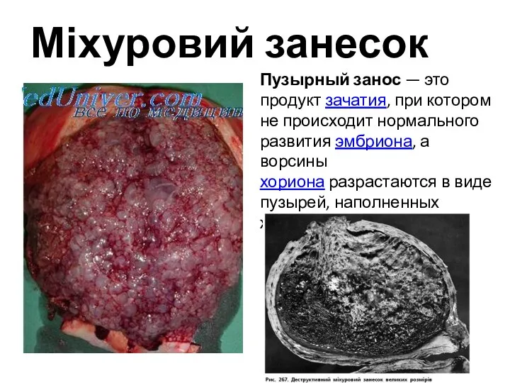 Міхуровий занесок Пузырный занос — это продукт зачатия, при котором не происходит