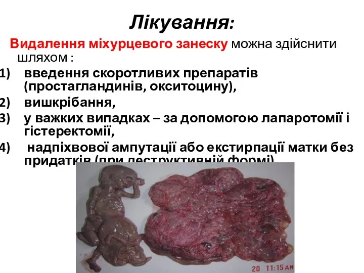 Лікування: Видалення міхурцевого занеску можна здійснити шляхом : введення скоротливих препаратів (простагландинів,