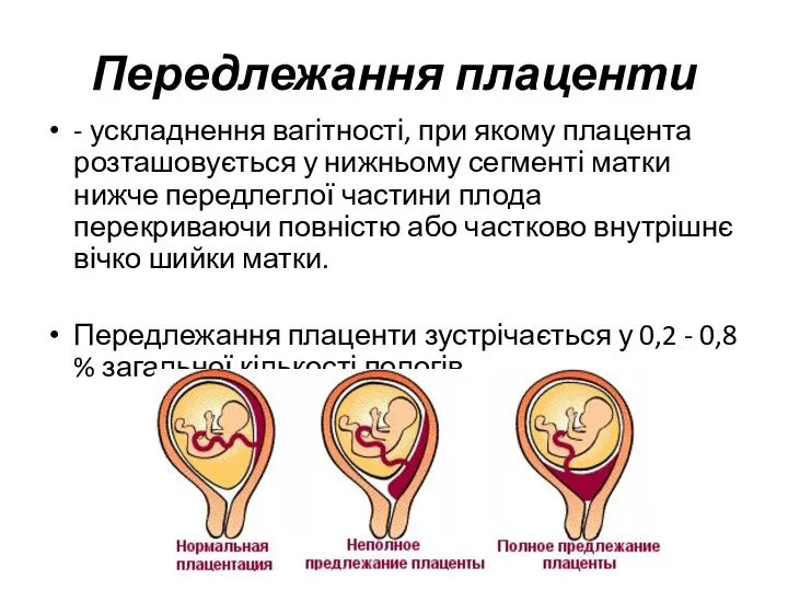 Передлежання плаценти - ускладнення вагітності, при якому плацента розташовується у нижньому сегменті