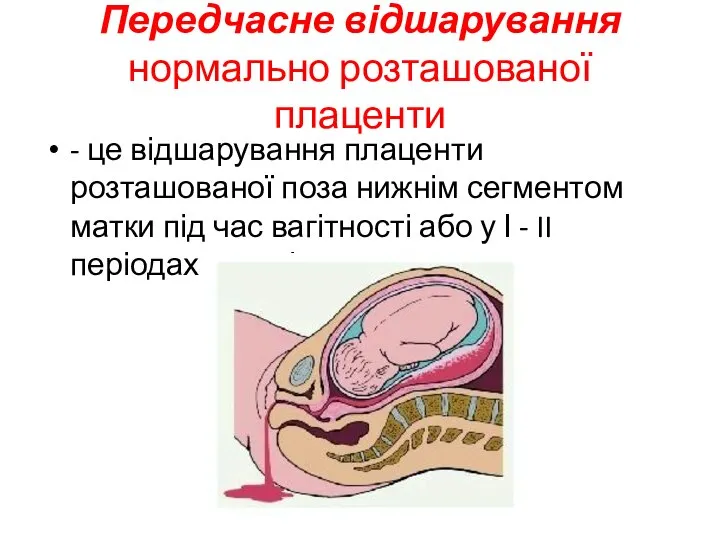 Передчасне відшарування нормально розташованої плаценти - це відшарування плаценти розташованої поза нижнім