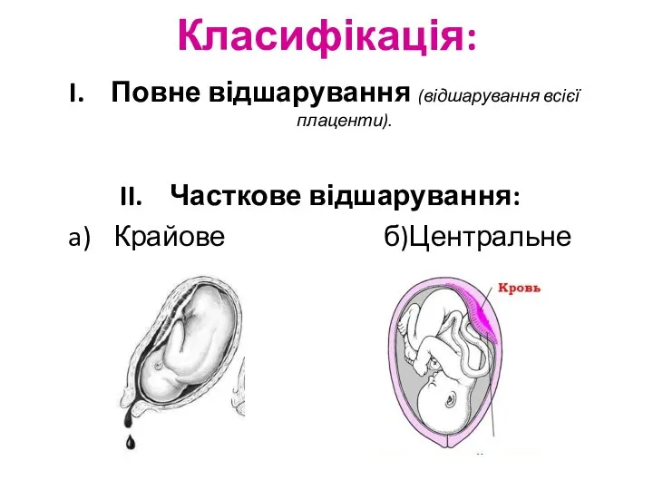 Класифікація: Повне відшарування (відшарування всієї плаценти). Часткове відшарування: Крайове б)Центральне