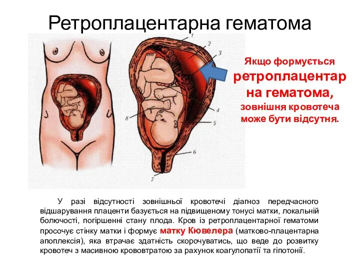 Ретроплацентарна гематома У разі відсутності зовнішньої кровотечі діагноз передчасного відшарування плаценти базується