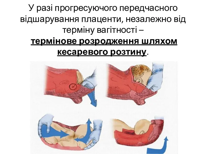 У разі прогресуючого передчасного відшарування плаценти, незалежно від терміну вагітності – термінове розродження шляхом кесаревого розтину.