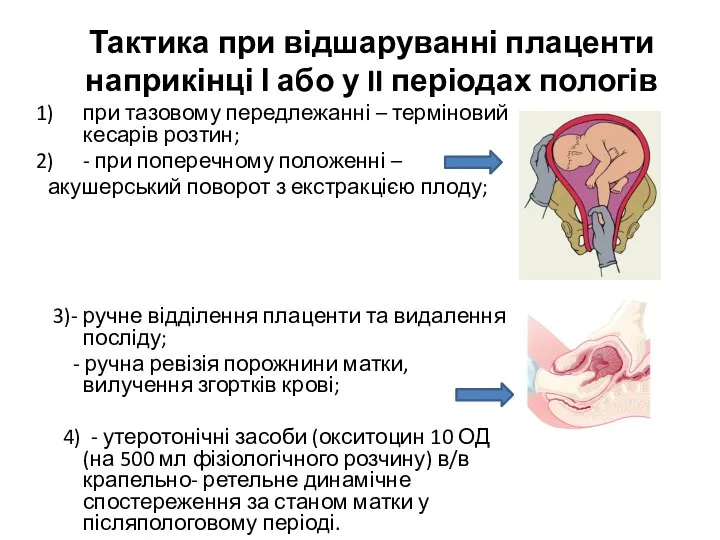 Тактика при відшаруванні плаценти наприкінці І або у II періодах пологів при