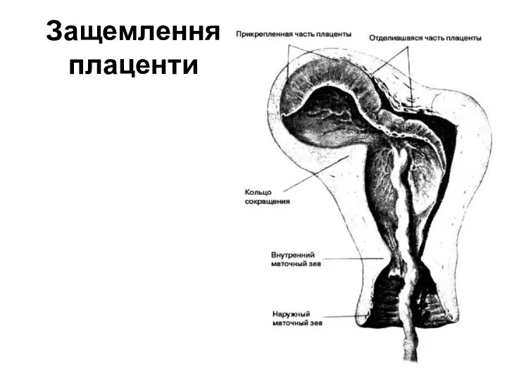 Защемлення плаценти