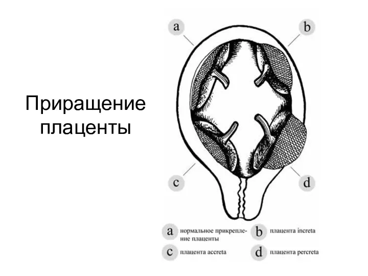 Приращение плаценты