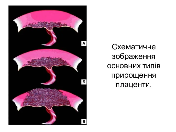 Схематичне зображення основних типів прирощення плаценти.