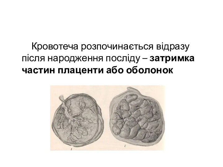 Кровотеча розпочинається відразу після народження посліду – затримка частин плаценти або оболонок