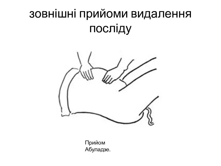 зовнішні прийоми видалення посліду Прийом Абуладзе.