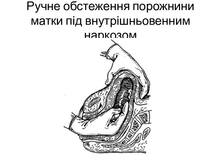 Ручне обстеження порожнини матки під внутрішньовенним наркозом