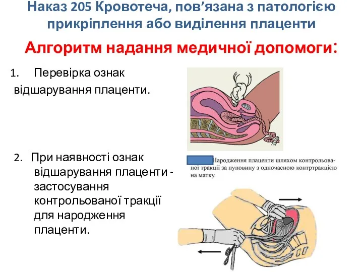 Наказ 205 Кровотеча, пов’язана з патологією прикріплення або виділення плаценти Алгоритм надання