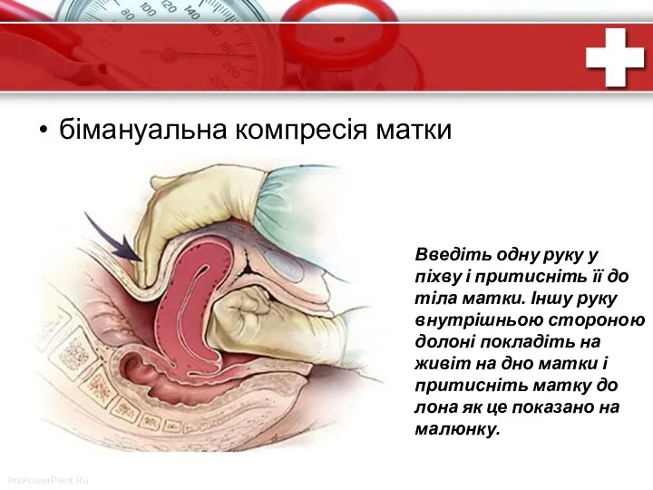 бімануальна компресія матки Введіть одну руку у піхву і притисніть її до