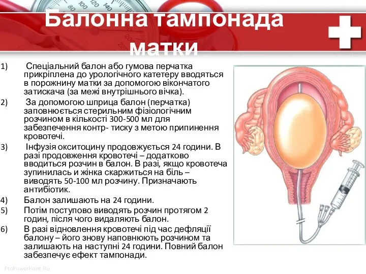 Балонна тампонада матки Спеціальний балон або гумова перчатка прикріплена до урологічного катетеру