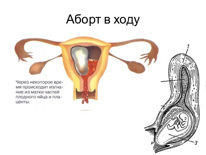 Аборт в ходу