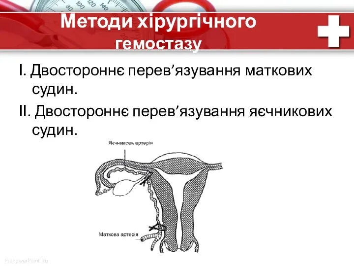 Методи хірургічного гемостазу І. Двостороннє перев’язування маткових судин. ІІ. Двостороннє перев’язування яєчникових судин.