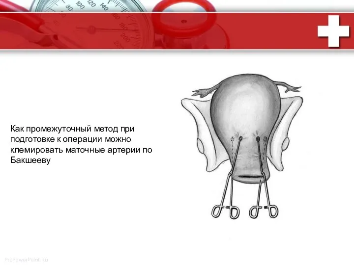 Как промежуточный метод при подготовке к операции можно клемировать маточные артерии по Бакшееву