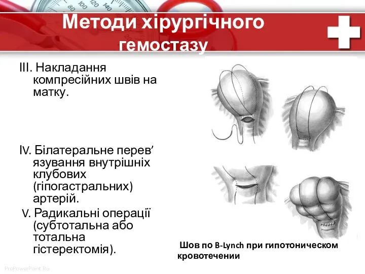 Методи хірургічного гемостазу ІІІ. Накладання компресійних швів на матку. ІV. Білатеральне перев’язування