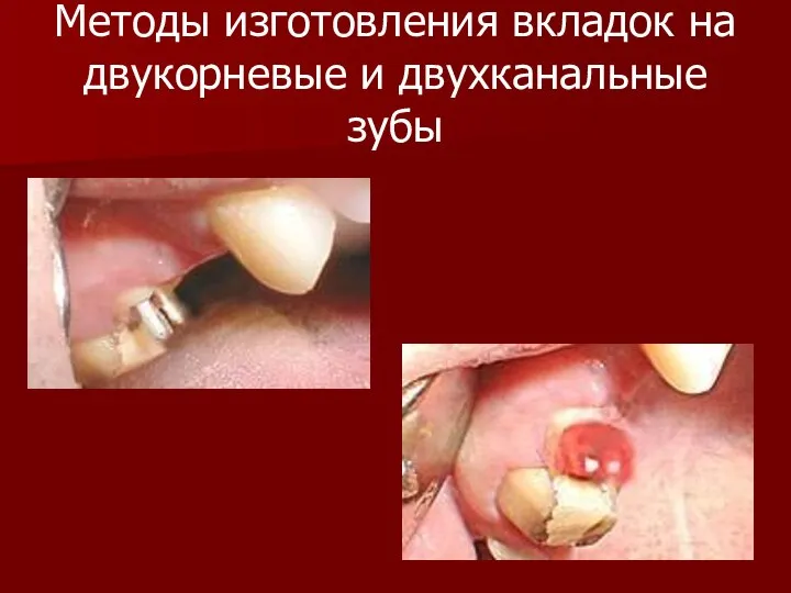 Методы изготовления вкладок на двукорневые и двухканальные зубы