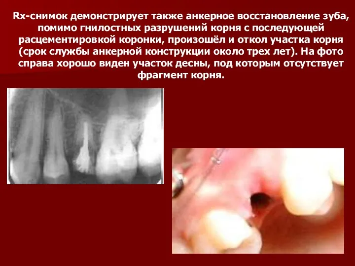 Rx-снимок демонстрирует также анкерное восстановление зуба, помимо гнилостных разрушений корня с последующей
